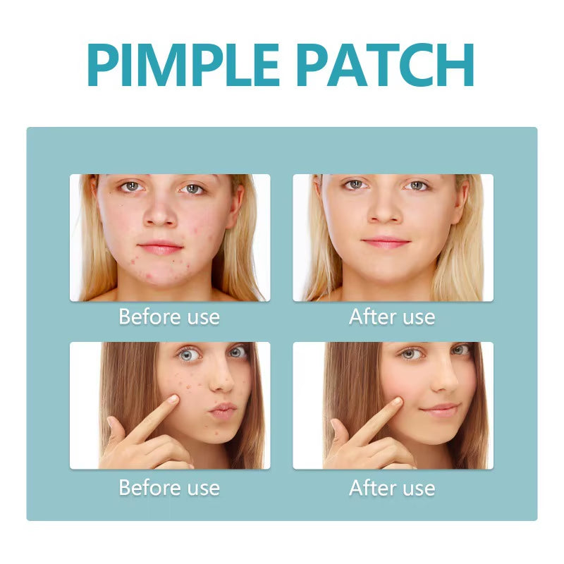 Hydrocolloid Acne Patch Repair